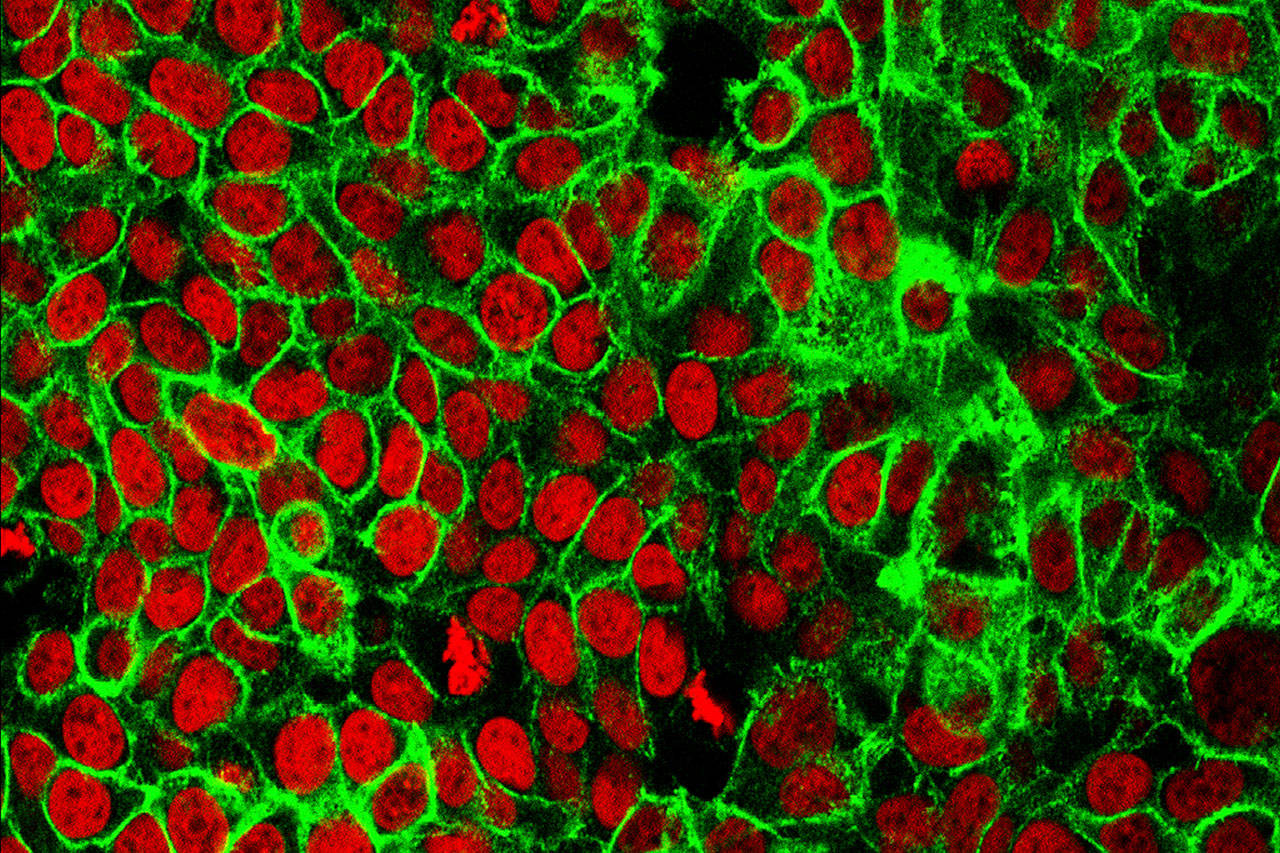 This microscope image made available by the National Cancer Institute Center for Cancer Research in 2015 shows human colon cancer cells with the nuclei stained red. On Friday, May 29, 2020, doctors are reporting success with newer drugs that control certain types of cancer better, reduce the risk it will come back and make treatment simpler and easier to bear. (NCI Center for Cancer Research via AP)
